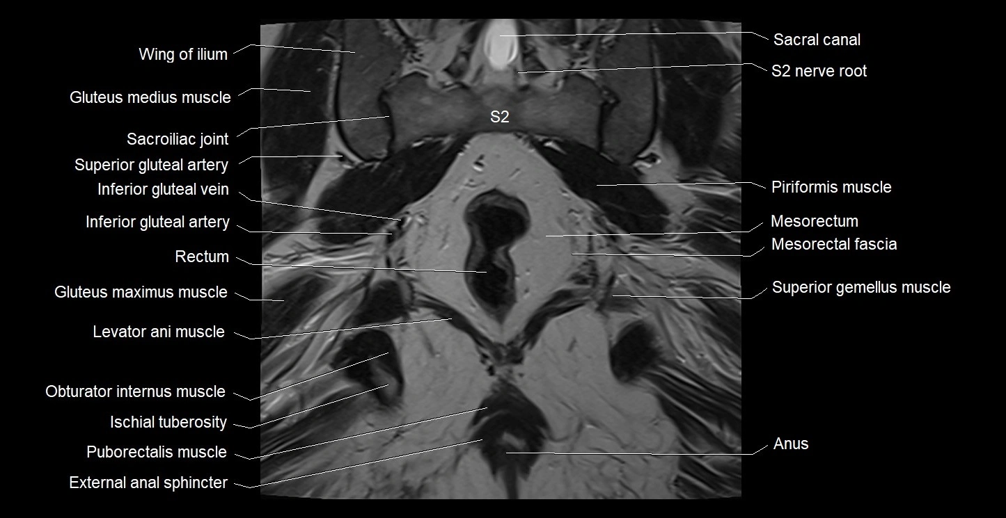 MRI coronal cross sectional anatomy male pelvis image 32.webp